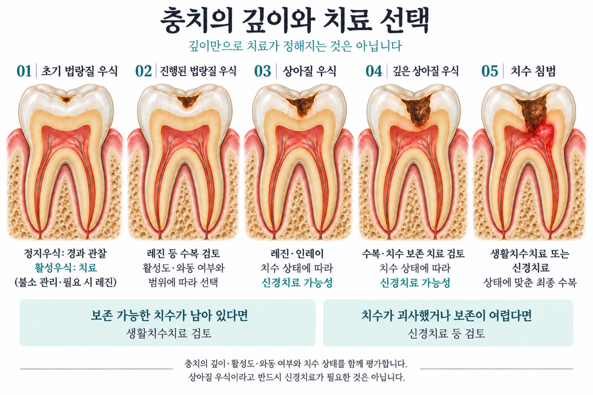 충치 깊이와 치수 상태에 따른 치료 선택 개념도
